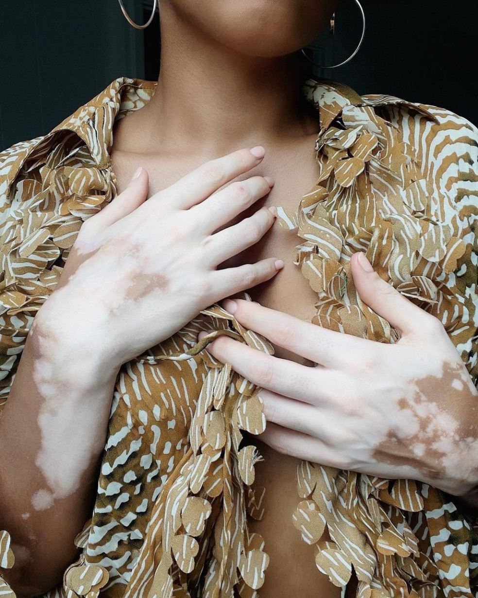 vitiligo choroba