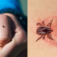 Lymská borelióza pod lupou: Čo by ste mali vedieť o tejto kliešťami prenášanej infekcii?
