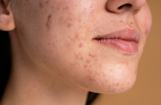Starostlivosť o aknóznu pleť krok za krokom – tipy a najlepšia kozmetika